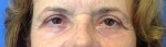 Blepharoplasty