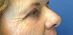 Blepharoplasty