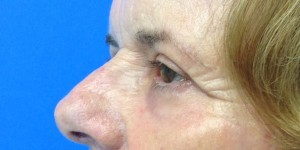 Blepharoplasty