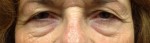 Blepharoplasty