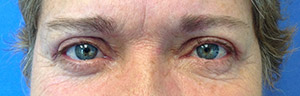 Blepharoplasty