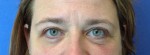 Blepharoplasty