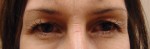 Blepharoplasty