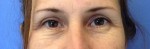 Blepharoplasty