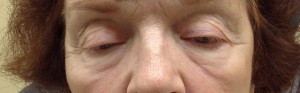 Ptosis Result Fort Myers