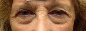 Blepharoplasty