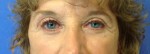 Blepharoplasty