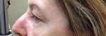 Blepharoplasty