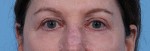 Blepharoplasty