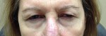 Blepharoplasty