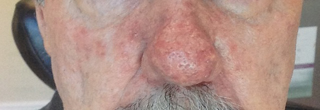 Before Laser Skin Resurfacing Photo of Nose” width=