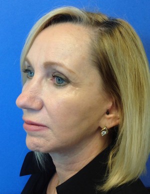 Botox® after photo by Dr. Stephen Laquis in Fort Myers