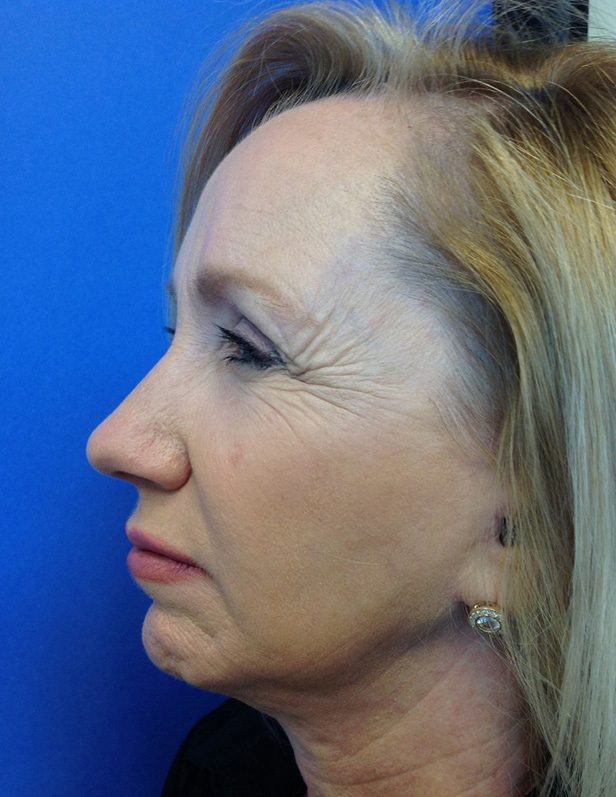 Botox® before photo by Dr. Stephen Laquis in Fort Myers