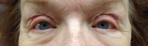 After Eyelid Surgery Photo of Eyes